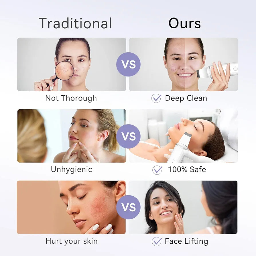 Skin Scrubber, ANLAN Ultrasonic EMS Ion Exfoliating Device Face Cleanser and Blackhead Remover Pores Cleaning Wrinkle Remover Comedone Extractor Skin Care with 4 Modes USB Rechargeable