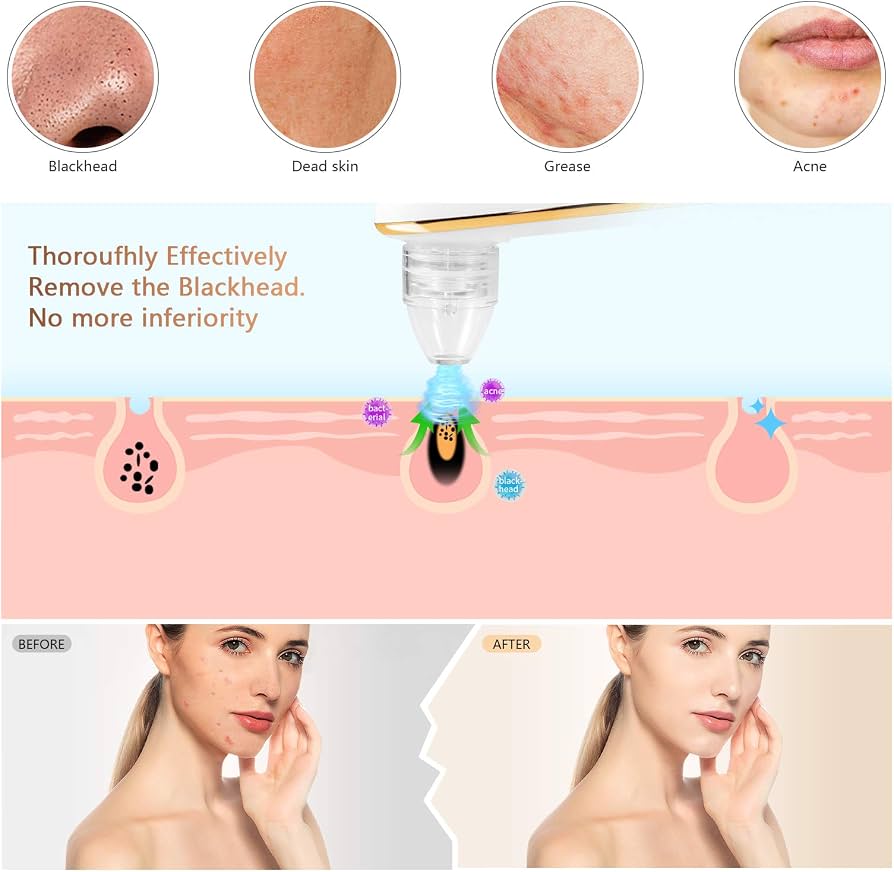 YODI Blackhead Remover Vacuum