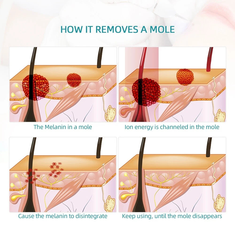 Laser Plasma Pen Mole Removal