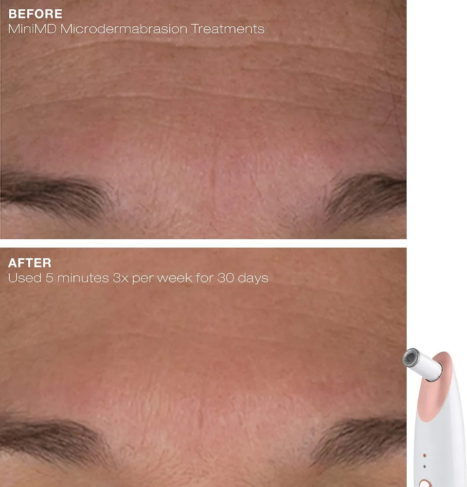 Trophy Skin MiniMD Mini Handheld Microdermabrasion System