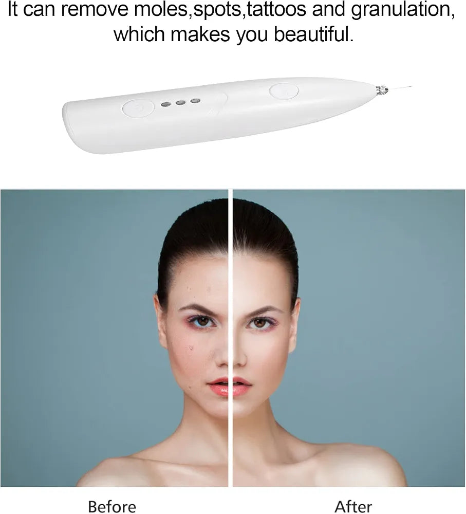 Mini Freckle Pen  Beauty Pen Moles Spots Tattoos Remover