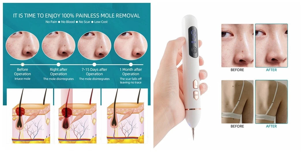 Laser Plasma Pen Mole Removal